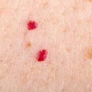 Campbell de morgan spot removal treatment for cherry angiomas.