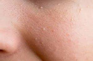 Milia removal treatment targeting small white bumps on the skin.