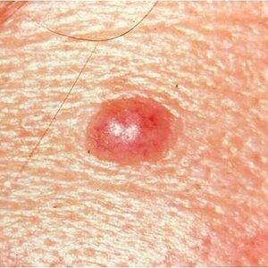 Mole assessment and removal treatment for benign skin moles.