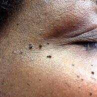 Dermatosis papulosa nigra removal treatment targeting small dark skin growths.