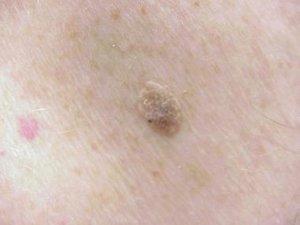 Seborrhoeic keratosis removal treatment targeting benign raised skin lesions.
