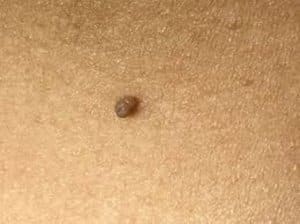 Skin tag removal treatment safely removing benign skin growths.