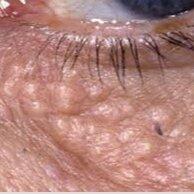 Syringoma removal treatment reducing small sweat gland bumps around the eyes.
