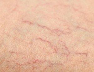 Telangiectasia treatment reducing the appearance of visible broken capillaries.
