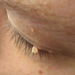 Wart removal treatment targeting common and stubborn skin warts.