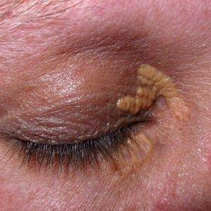 Xanthelasma treatment targeting cholesterol deposits around the eyes.