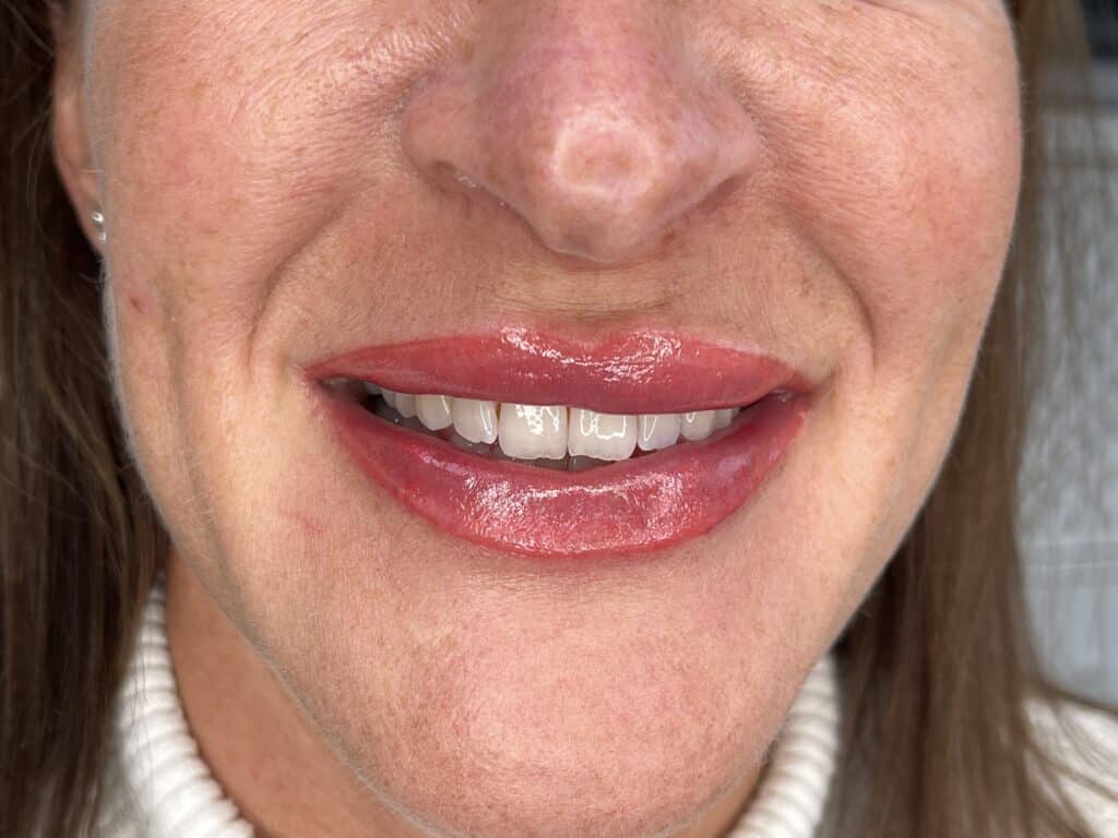 Permanent lip blush results creating even, balanced colour.